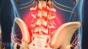 Posterior view of the lumbar spine showing pain in the lower back.
