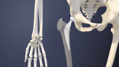Artificial joint in the hip
