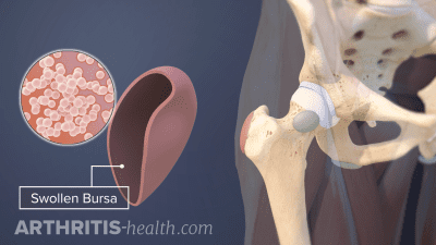 Swollen Hip Bursa