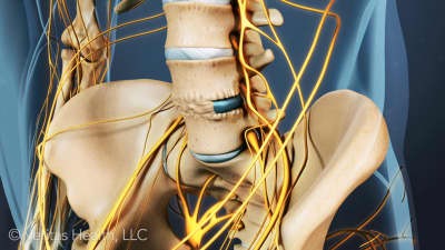 Spinal Fusion