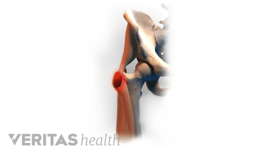 Medical illustration of trochanteric bursitis