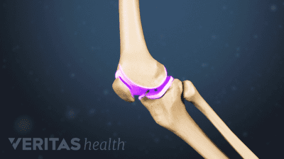 Profile view of the knee highlighting the cartilage.