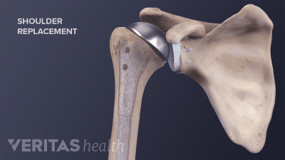 Anterior view showing a shoulder replacement in the shoulder
