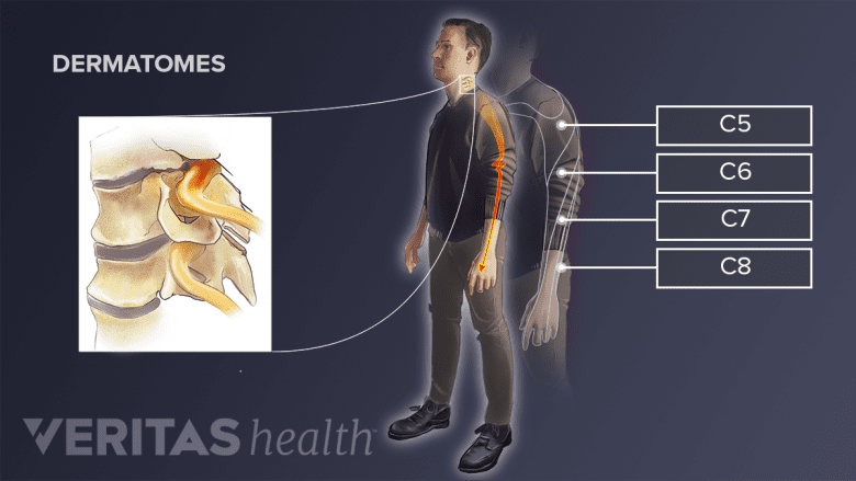 Medical illustration of the pain areas of different compressed nerve roots in the cervical spine