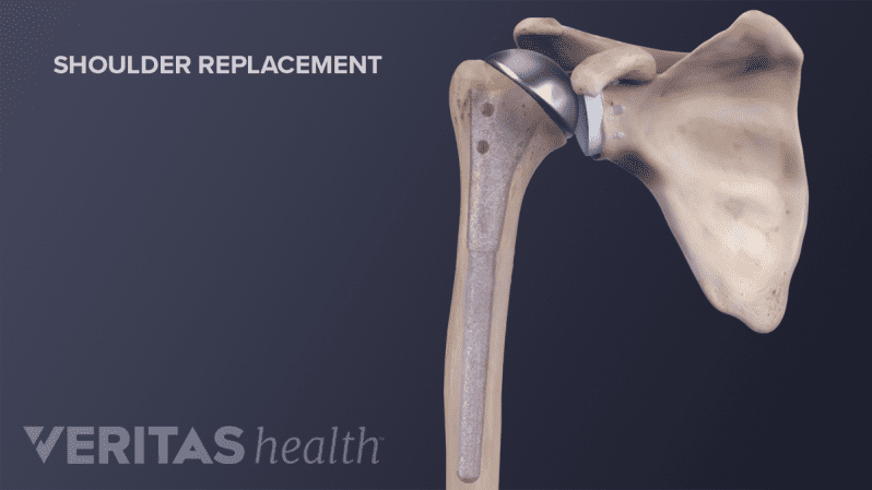 Uncemented shoulder joint replacement.