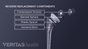 Illustration showing the medical devices needed for a reverse replacement shoulder surgery. The following items are shown and labeled: glenoid sphere, compression screws, plastic spacer, humeral stem