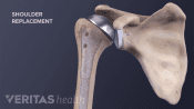Medical illustration of the bones in the shoulder after having undergone a shoulder replacement